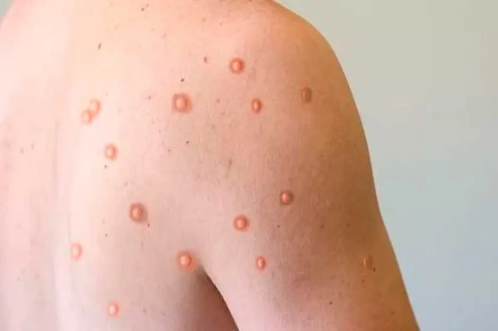  Los dos pacientes rionegrinos fueron dados de alta en Buenos Aires