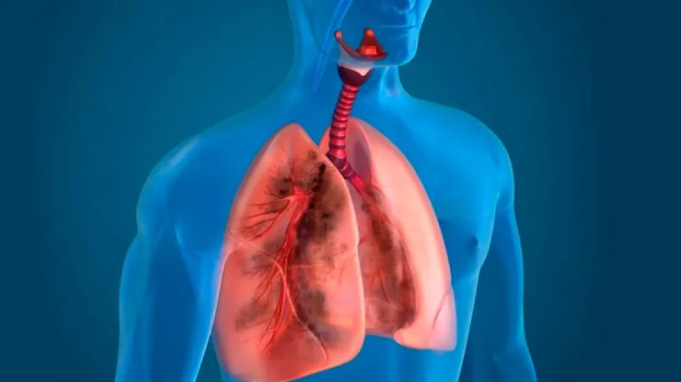 Tucumán: el Ministerio de Salud confirmó que ya son dos las víctimas mortales por la extraña neumonía  