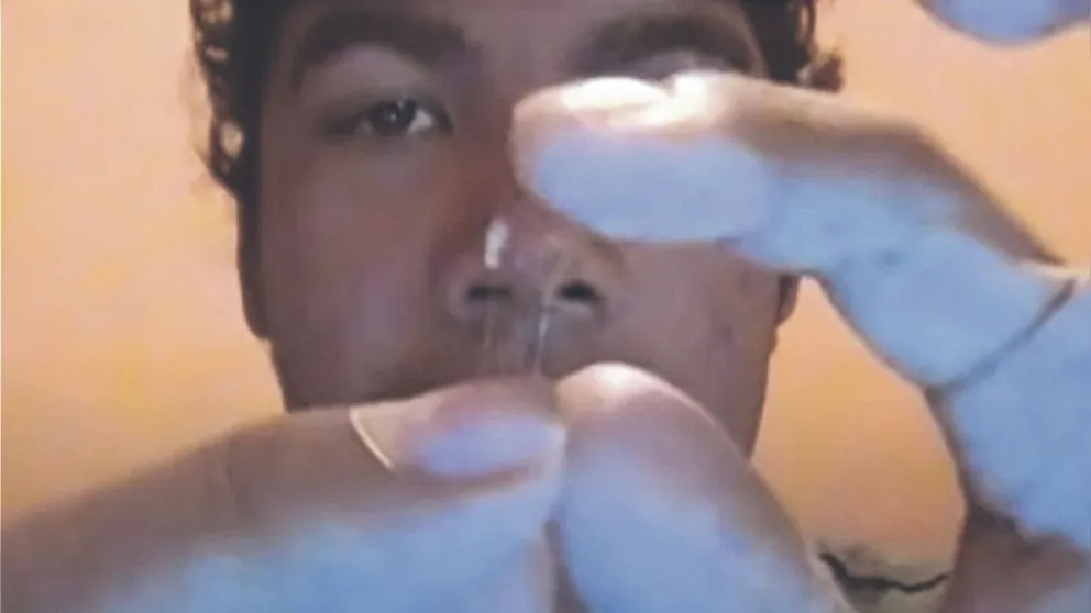 Insólito: se hizo una cirugía estética en su casa viendo un tutorial y casi pierde la vida