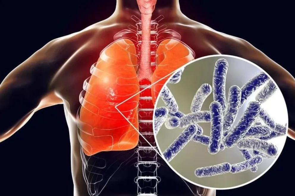 Legionella en Tucumán: se confirmaron 8 nuevos casos