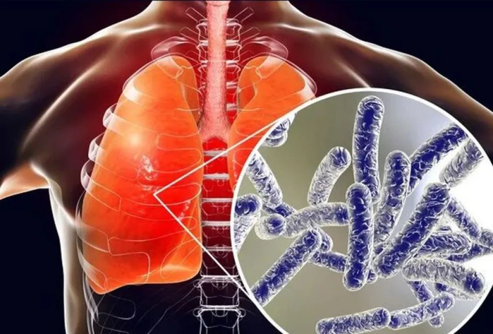 Legionella: la OMS brindó algunas recomendaciones para prevenir la enfermedad