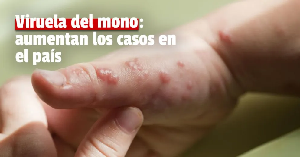 Viruela del mono: Salud confirmó que hay 170 casos detectados en el país