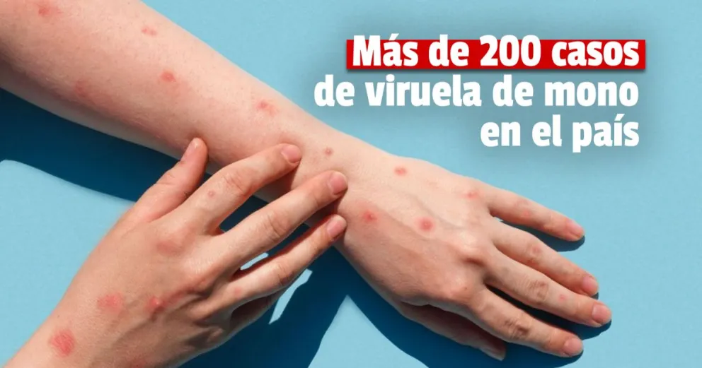 Viruela del mono: confirmaron 221 casos en la Argentina, un 30% más que la semana pasada