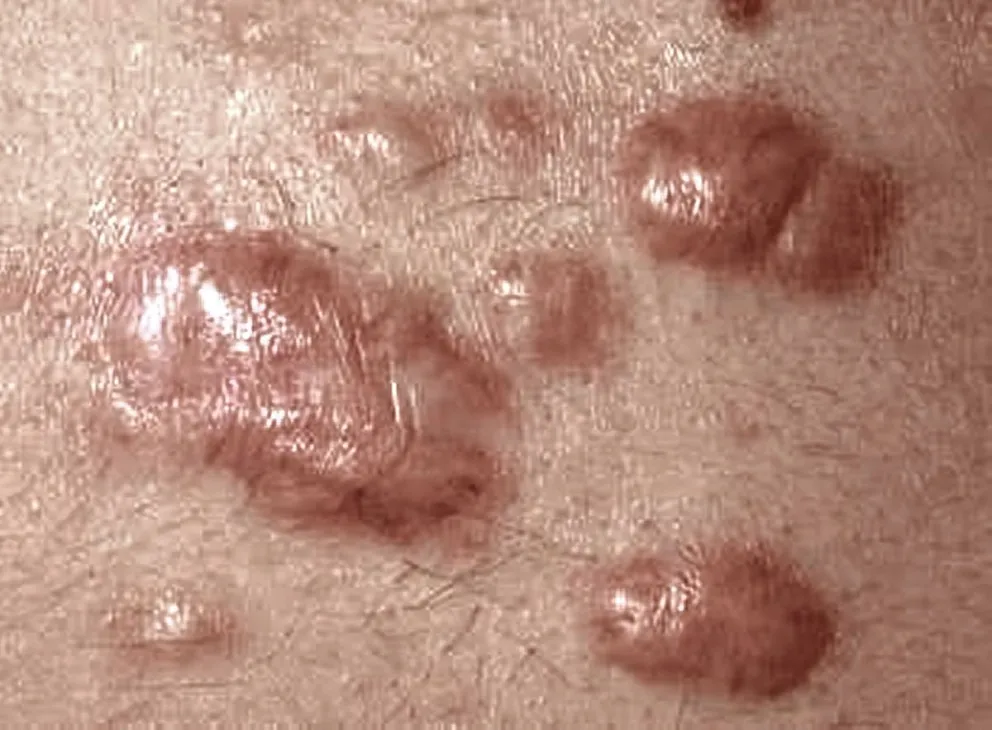 ¿Qué es un queloide?