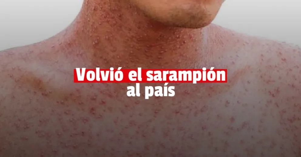 Confirmaron un caso de sarampión en Argentina después del brote de 2020
