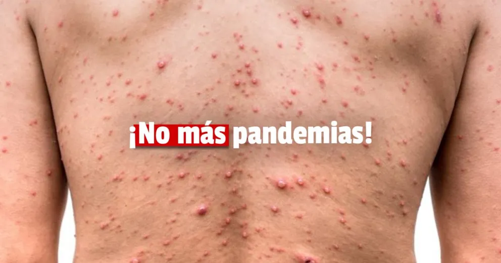 La OMS está preocupada por la suba de viruela del mono en el mundo