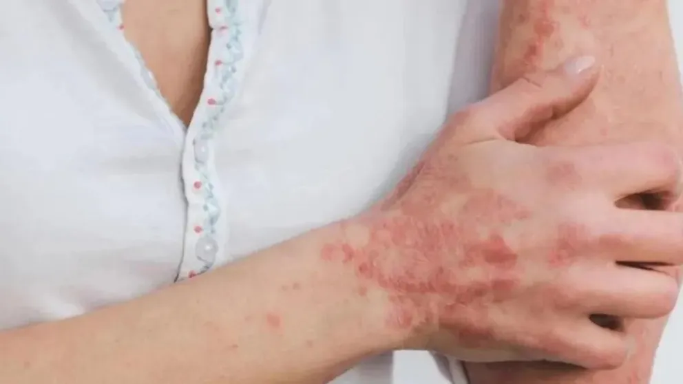ES OFICIAL: declaran emergencia sanitaria a nivel mundial por la viruela del mono