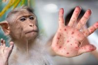 De mal en peor: ya son 72 los casos de viruela del mono en la Argentina
