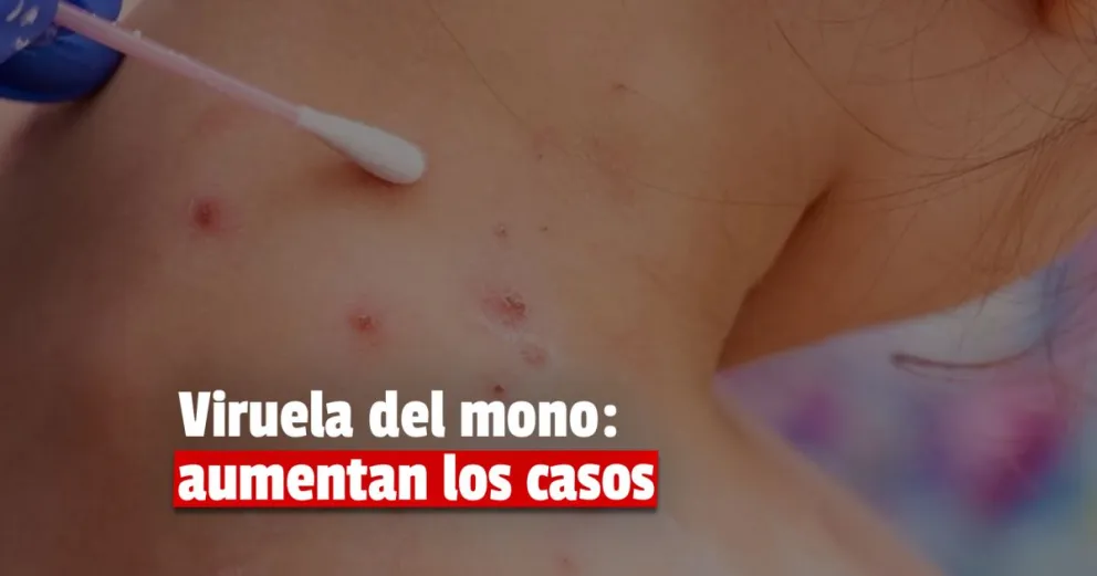 Viruela del mono: hay 24 casos confirmados en el país