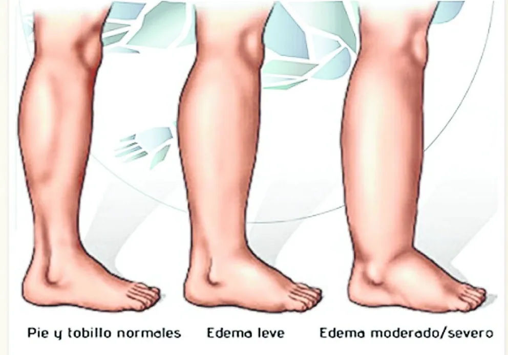 EDEMA