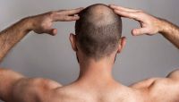 Adiós a la calvicie: científicos hallan una molécula que pondría fin a la alopecia