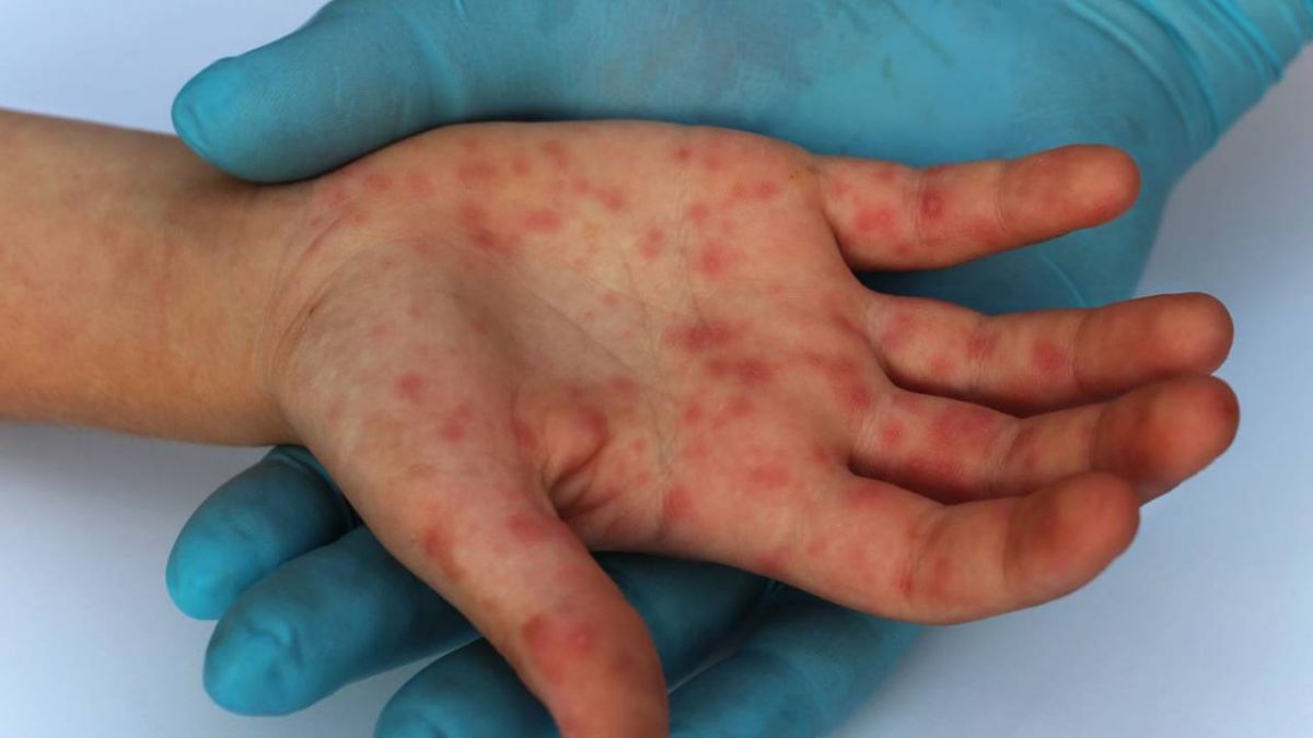 Buscan prevenir la Viruela Símica en Río Negro