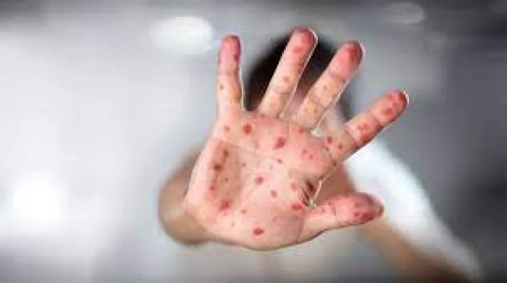 Confirmar siete nuevos casos de viruela del mono en el país