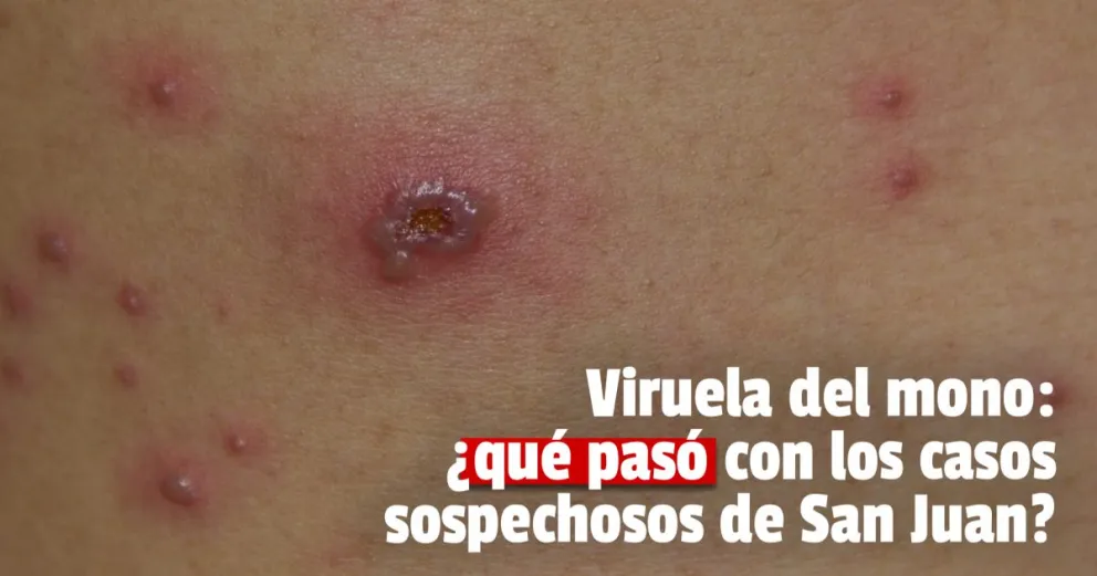 Descartaron dos casos sospechosos de viruela del mono en la provincia