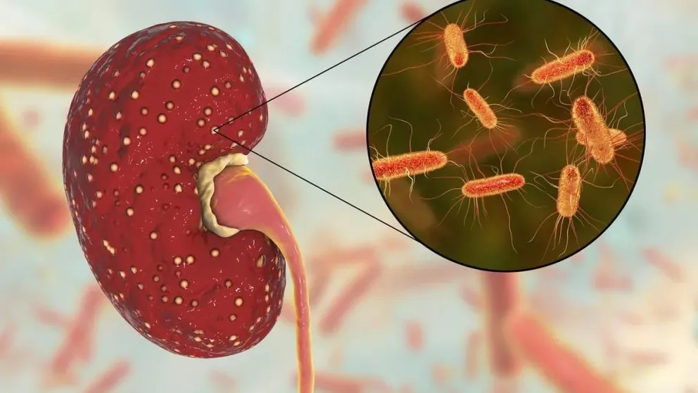 Síndrome Urémico Hemolítico: un virus que afecta a niños y niñas 