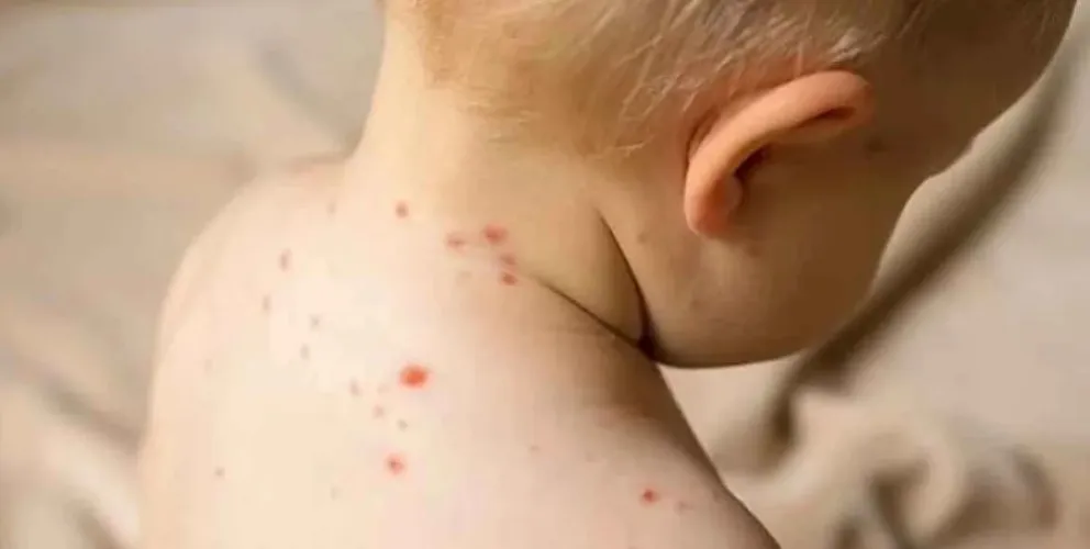 Preocupante: apareció una enfermedad que ataca a los más pequeños