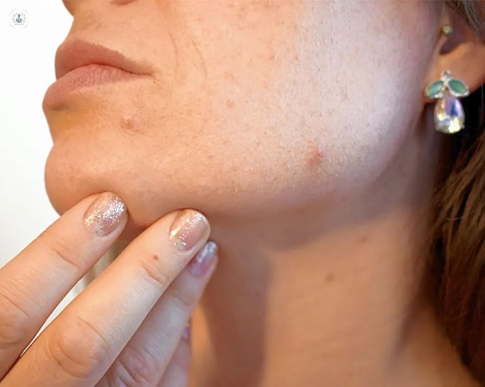 Acné en la mujer adulta. ¿Siempre es hormonal?
